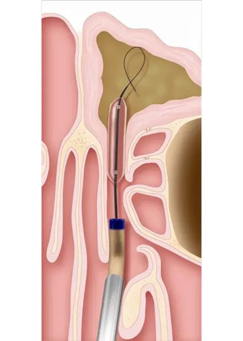 balloon sinuplasty